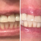 PurelyWHITE | Teeth Brightening Powder