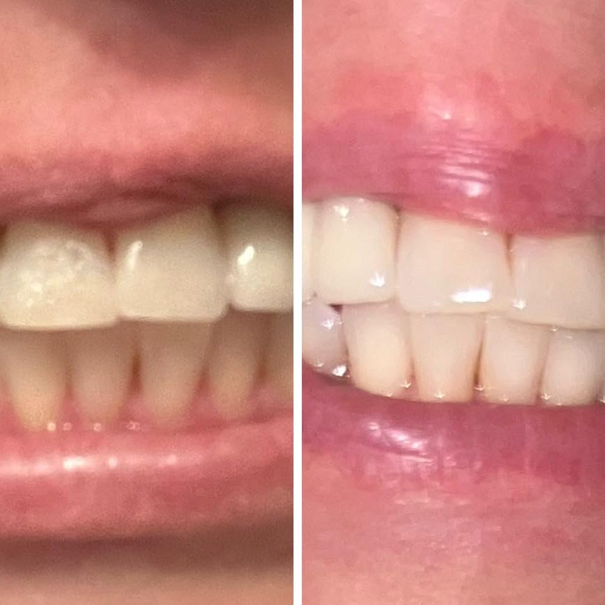 PurelyWHITE | Teeth Brightening Powder