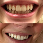 PurelyWHITE | Teeth Brightening Powder